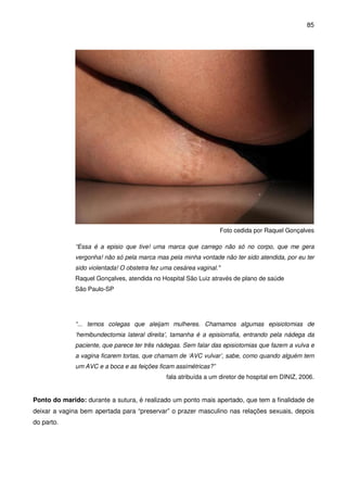 85
Foto cedida por Raquel Gonçalves
“Essa é a episio que tive! uma marca que carrego não só no corpo, que me gera
vergonha! não só pela marca mas pela minha vontade não ter sido atendida, por eu ter
sido violentada! O obstetra fez uma cesárea vaginal."
Raquel Gonçalves, atendida no Hospital São Luiz através de plano de saúde
São Paulo-SP
“... temos colegas que aleijam mulheres. Chamamos algumas episiotomias de
‘hemibundectomia lateral direita’, tamanha é a episiorrafia, entrando pela nádega da
paciente, que parece ter três nádegas. Sem falar das episiotomias que fazem a vulva e
a vagina ficarem tortas, que chamam de ‘AVC vulvar’, sabe, como quando alguém tem
um AVC e a boca e as feições ficam assimétricas?”
fala atribuída a um diretor de hospital em DINIZ, 2006.
Ponto do marido: durante a sutura, é realizado um ponto mais apertado, que tem a finalidade de
deixar a vagina bem apertada para “preservar” o prazer masculino nas relações sexuais, depois
do parto.
 
