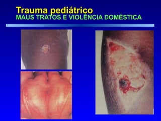 Trauma pediátrico  MAUS TRATOS E VIOLÊNCIA DOMÉSTICA 