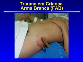 Trauma em Criança  Arma Branca (FAB) 