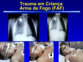 Trauma em Criança  Arma de Fogo (FAF) 