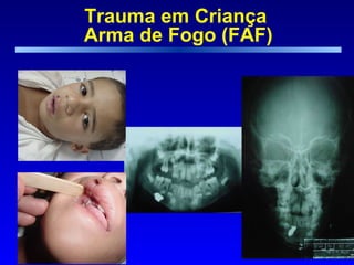 Trauma em Criança  Arma de Fogo (FAF) 
