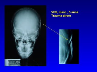 VSS, masc., 5 anos Trauma direto 