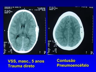 VSS, masc., 5 anos Trauma direto Contusão  Pneumoencéfalo 