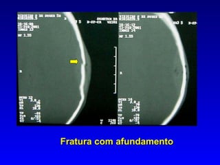 Fratura com afundamento 