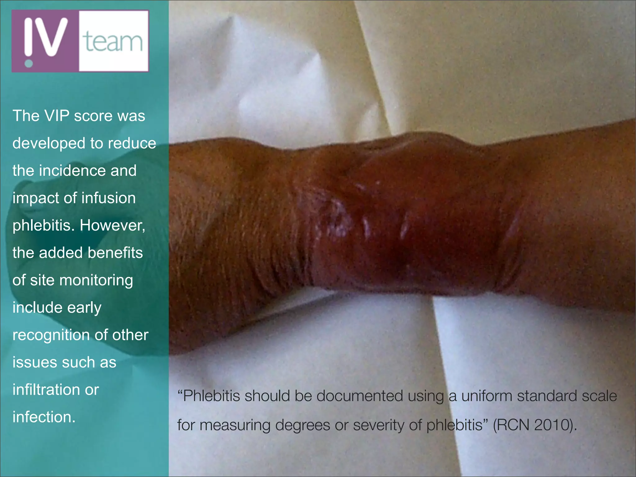 The VIP score was
developed to reduce
the incidence and
impact of infusion
phlebitis. However,
the added benefits
of site monitoring
include early
recognition of other
issues such as
infiltration or        “Phlebitis should be documented using a uniform standard scale
infection.             for measuring degrees or severity of phlebitis” (RCN 2010).
 