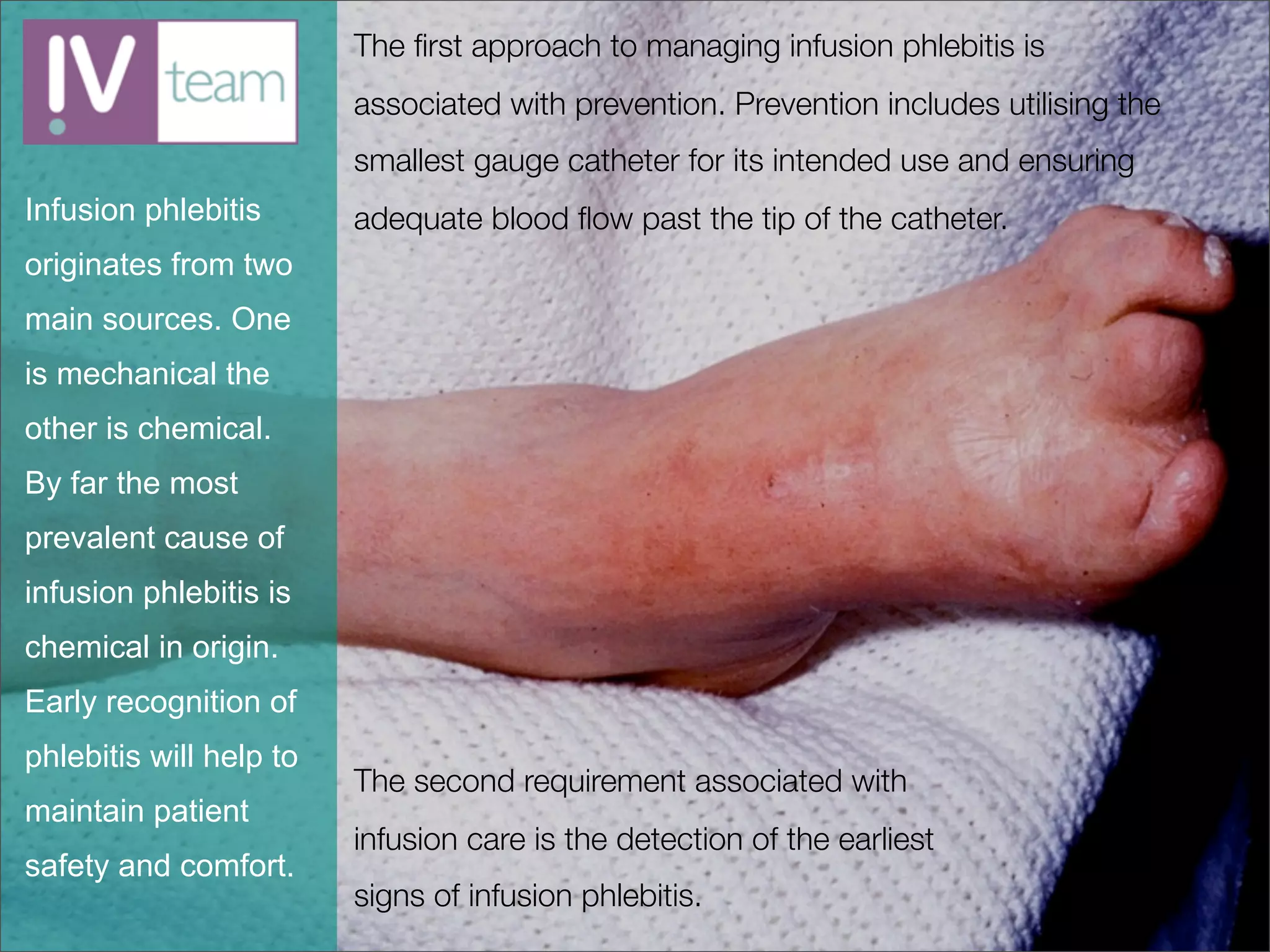 The ﬁrst approach to managing infusion phlebitis is
                         associated with prevention. Prevention includes utilising the
                         smallest gauge catheter for its intended use and ensuring
Infusion phlebitis       adequate blood ﬂow past the tip of the catheter.
originates from two
main sources. One
is mechanical the
other is chemical.
By far the most
prevalent cause of
infusion phlebitis is
chemical in origin.
Early recognition of
phlebitis will help to
                         The second requirement associated with
maintain patient
                         infusion care is the detection of the earliest
safety and comfort.
                         signs of infusion phlebitis.
 