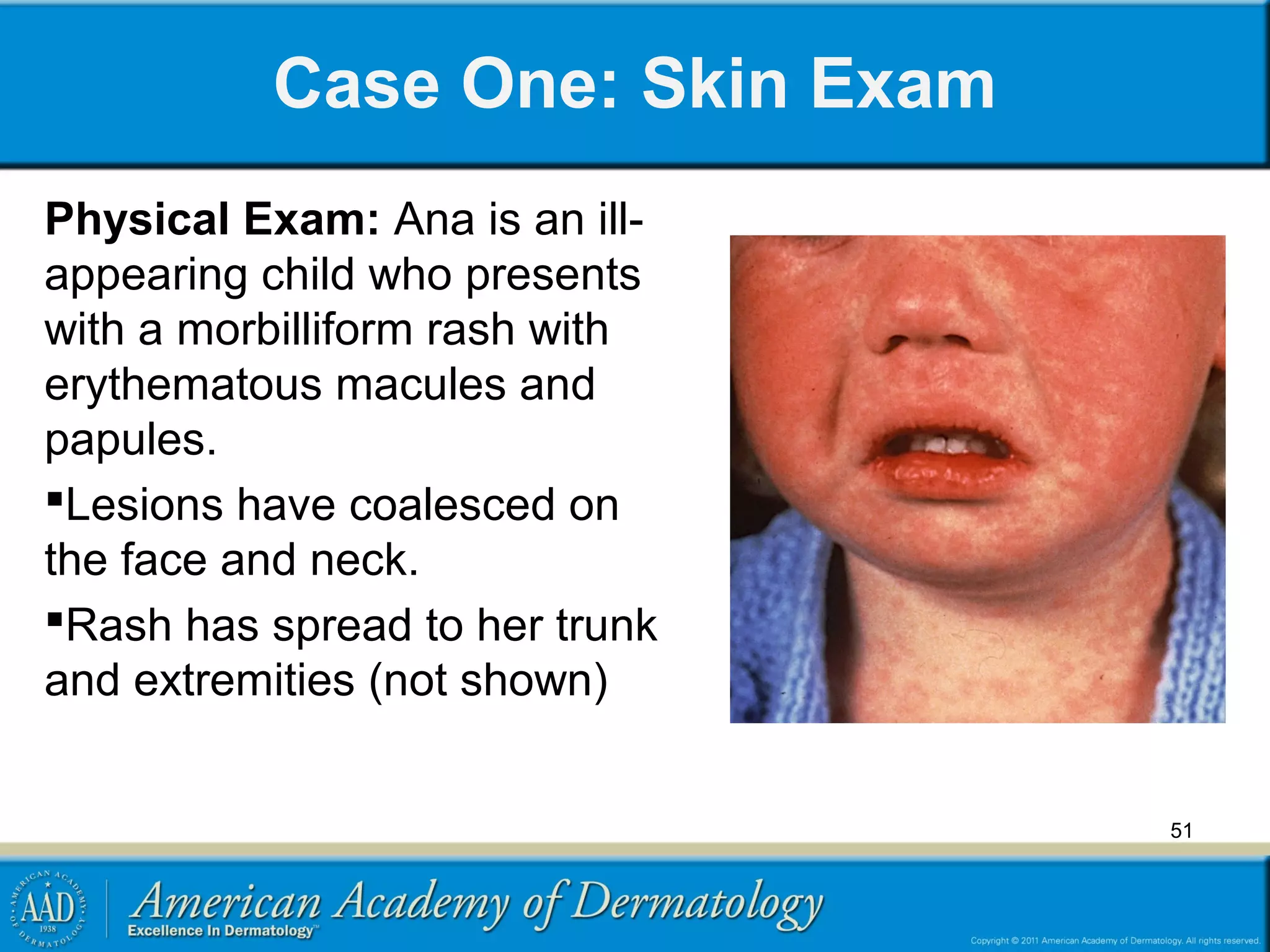 Viral exanthems | PPT