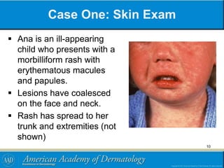 Case One: Skin Exam
 Ana is an ill-appearing
child who presents with a
morbilliform rash with
erythematous macules
and papules.
 Lesions have coalesced
on the face and neck.
 Rash has spread to her
trunk and extremities (not
shown)
10
 