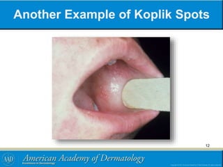 Another Example of Koplik Spots
12
 