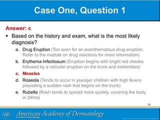 Case One, Question 1
Answer: c
 Based on the history and exam, what is the most likely
diagnosis?
a. Drug Eruption (Too soon for an exanthematous drug eruption.
Refer to the module on drug reactions for more information)
b. Erythema Infectiosum (Eruption begins with bright red cheeks
followed by a reticular eruption on the trunk and extremities)
c. Measles
d. Roseola (Tends to occur in younger children with high fevers
preceding a sudden rash that begins on the trunk)
e. Rubella (Rash tends to spread more quickly, covering the body
in 24hrs)
14
 