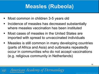 Measles (Rubeola)
 Most common in children 3-5 years old
 Incidence of measles has decreased substantially
where measles vaccination has been instituted
 Most cases of measles in the United States are
imported with spread to unvaccinated individuals
 Measles is still common in many developing countries
(parts of Africa and Asia) and outbreaks repeatedly
occur in communities who do not accept vaccinations
(e.g. religious community in Netherlands)
16
 