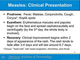 Measles: Clinical Presentation
 Prodrome: Fever, Malaise, Conjunctivitis, Cough,
Coryza*, Koplik spots
 Exanthem: Erythematous macules and papules
begin on the face and spread cephalocaudally and
centrifugally (by the 3rd day, the whole body is
involved).
 Recovery: Clinical improvement begins within 2
days of appearance of the rash. The rash tends to
fade after 3-4 days and will last around 6-7 days.
*Coryza: “head cold” with nasal congestion, rhinorrhea, sore throat
17
 