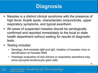 Diagnosis
 Measles is a distinct clinical syndrome with the presence of
high fever, Koplik spots, characteristic conjunctivitis, upper
respiratory symptoms, and typical exanthem.
 All cases of suspected measles should be serologically
confirmed and reported immediately to the local or state
health department without waiting for results of diagnostic
tests.
 Testing includes:
• Serology: Anti-measles IgM and IgG, isolation of measles virus or
identification of measles RNA
• Histologic evaluation of skin lesions or respiratory secretions may
show syncytial keratinocytic giant cells
18
 