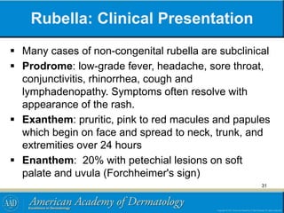 Rubella: Clinical Presentation
 Many cases of non-congenital rubella are subclinical
 Prodrome: low-grade fever, headache, sore throat,
conjunctivitis, rhinorrhea, cough and
lymphadenopathy. Symptoms often resolve with
appearance of the rash.
 Exanthem: pruritic, pink to red macules and papules
which begin on face and spread to neck, trunk, and
extremities over 24 hours
 Enanthem: 20% with petechial lesions on soft
palate and uvula (Forchheimer's sign)
31
 