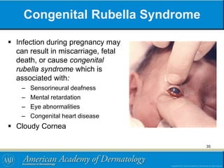 Congenital Rubella Syndrome
 Infection during pregnancy may
can result in miscarriage, fetal
death, or cause congenital
rubella syndrome which is
associated with:
– Sensorineural deafness
– Mental retardation
– Eye abnormalities
– Congenital heart disease
 Cloudy Cornea
35
 