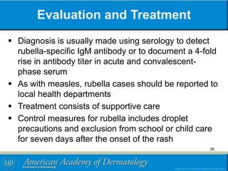 Evaluation and Treatment
 Diagnosis is usually made using serology to detect
rubella-specific IgM antibody or to document a 4-fold
rise in antibody titer in acute and convalescent-
phase serum
 As with measles, rubella cases should be reported to
local health departments
 Treatment consists of supportive care
 Control measures for rubella includes droplet
precautions and exclusion from school or child care
for seven days after the onset of the rash
36
 