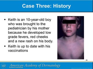 Case Three: History
 Keith is an 10-year-old boy
who was brought to the
pediatrician by his mother
because he developed low
grade fevers, red cheeks
and a new rash on his body.
 Keith is up to date with his
vaccinations
38
 