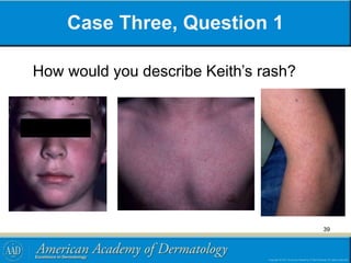 Case Three, Question 1
How would you describe Keith’s rash?
39
 