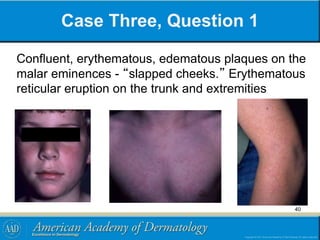 Case Three, Question 1
Confluent, erythematous, edematous plaques on the
malar eminences - “slapped cheeks.” Erythematous
reticular eruption on the trunk and extremities
40
 