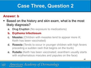 Case Three, Question 2
Answer: b
 Based on the history and skin exam, what is the most
likely diagnosis?
a. Drug Eruption (No exposure to medications)
b. Erythema Infectiosum
c. Measles (Children with measles tend to appear more ill;
Keith has been vaccinated)
d. Roseola (Tends to occur in younger children with high fevers
preceding a sudden rash that begins on the trunk)
e. Rubella (Keith has been vaccinated; exanthem usually starts
with erythematous macules and papules on the face)
42
 