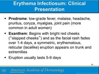 Erythema Infectiosum: Clinical
Presentation
 Prodrome: low-grade fever, malaise, headache,
pruritus, coryza, myalgias, joint pain (more
common in adult women)
 Exanthem: Begins with bright red cheeks
(“slapped cheeks”) and as the facial rash fades
over 1-4 days, a symmetric, erythematous,
reticular (lacelike) eruption appears on trunk and
extremities
 Eruption usually lasts 5-9 days
46
 
