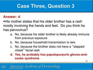 Case Three, Question 3
Answer: d
His mother states that his older brother has a rash
mostly involving the hands and feet. Do you think he
has parvovirus?
a. No, because his older brother is likely already immune
from previous exposure
b. No, because household transmission is rare
c. No, because the brother does not have a “slapped
cheek” facial rash
d. Yes, he probably has papulopurpuric gloves-and-
socks syndrome
49
 