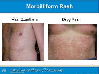 Morbilliform Rash
Viral Exanthem Drug Rash
5
 