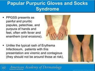 Papular Purpuric Gloves and Socks
Syndrome
 PPGSS presents as
painful and pruritic
papules, petechiae, and
purpura of hands and
feet, often with fever and
enanthem (oral erosions).
 Unlike the typical rash of Erythema
Infectiosum, patients with this
presentation are viremic and contagious
(they should not be around those at risk).
50
 