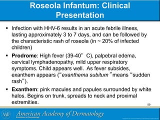 Roseola Infantum: Clinical
Presentation
 Infection with HHV-6 results in an acute febrile illness,
lasting approximately 3 to 7 days, and can be followed by
the characteristic rash of roseola (in ~ 20% of infected
children)
 Prodrome: High fever (39-40°C), palpebral edema,
cervical lymphadenopathy, mild upper respiratory
symptoms. Child appears well. As fever subsides,
exanthem appears (“exanthema subitum” means “sudden
rash”).
 Exanthem: pink macules and papules surrounded by white
halos. Begins on trunk, spreads to neck and proximal
extremities. 59
 