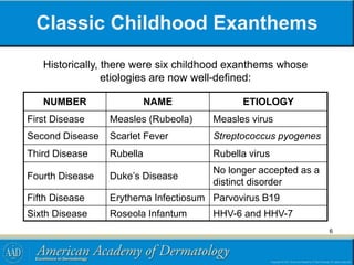 Classic Childhood Exanthems
Historically, there were six childhood exanthems whose
etiologies are now well-defined:
NUMBER NAME ETIOLOGY
First Disease Measles (Rubeola) Measles virus
Second Disease Scarlet Fever Streptococcus pyogenes
Third Disease Rubella Rubella virus
Fourth Disease Duke’s Disease
No longer accepted as a
distinct disorder
Fifth Disease Erythema Infectiosum Parvovirus B19
Sixth Disease Roseola Infantum HHV-6 and HHV-7
6
 