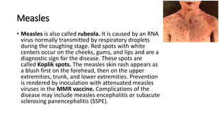 Measles
• Measles is also called rubeola. It is caused by an RNA
virus normally transmitted by respiratory droplets
during the coughing stage. Red spots with white
centers occur on the cheeks, gums, and lips and are a
diagnostic sign for the disease. These spots are
called Koplik spots. The measles skin rash appears as
a blush first on the forehead, then on the upper
extremities, trunk, and lower extremities. Prevention
is rendered by inoculation with attenuated measles
viruses in the MMR vaccine. Complications of the
disease may include measles encephalitis or subacute
sclerosing panencephalitis (SSPE).
 