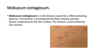 Molluscum contagiosum.
• Molluscum contagiosum is a skin disease caused by a DNA‐containing
poxvirus. The disease is accompanied by flesh‐colored, painless
lesions scattered over the skin surface. The disease is transmitted by
skin contact.
 