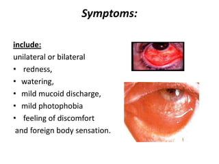 Symptoms:
include:
unilateral or bilateral
• redness,
• watering,
• mild mucoid discharge,
• mild photophobia
• feeling of discomfort
and foreign body sensation.
 