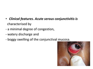 • Clinical features. Acute serous conjunctivitis is
characterised by
- a minimal degree of congestion,
- watery discharge and
- boggy swelling of the conjunctival mucosa.
 