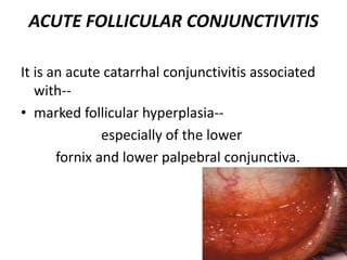 ACUTE FOLLICULAR CONJUNCTIVITIS
It is an acute catarrhal conjunctivitis associated
with--
• marked follicular hyperplasia--
especially of the lower
fornix and lower palpebral conjunctiva.
 