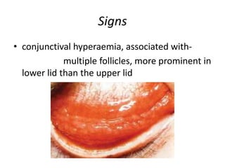Signs
• conjunctival hyperaemia, associated with-
multiple follicles, more prominent in
lower lid than the upper lid
 