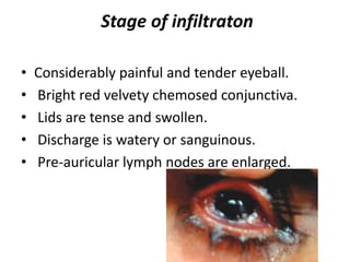 Stage of infiltraton
• Considerably painful and tender eyeball.
• Bright red velvety chemosed conjunctiva.
• Lids are tense and swollen.
• Discharge is watery or sanguinous.
• Pre-auricular lymph nodes are enlarged.
 