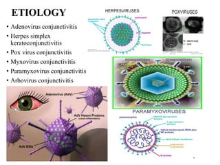 ETIOLOGY
• Adenovirus conjunctivitis
• Herpes simplex
keratoconjunctivitis
• Pox virus conjunctivitis
• Myxovirus conjunctivitis
• Paramyxovirus conjunctivitis
• Arbovirus conjunctivitis
 