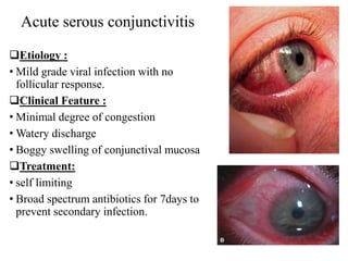 Acute serous conjunctivitis
Etiology :
• Mild grade viral infection with no
follicular response.
Clinical Feature :
• Minimal degree of congestion
• Watery discharge
• Boggy swelling of conjunctival mucosa
Treatment:
• self limiting
• Broad spectrum antibiotics for 7days to
prevent secondary infection.
 