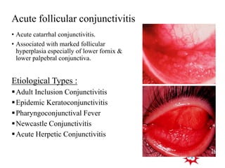 Acute follicular conjunctivitis
• Acute catarrhal conjunctivitis.
• Associated with marked follicular
hyperplasia especially of lower fornix &
lower palpebral conjunctiva.
Etiological Types :
Adult Inclusion Conjunctivitis
Epidemic Keratoconjunctivitis
Pharyngoconjunctival Fever
Newcastle Conjunctivitis
Acute Herpetic Conjunctivitis
 