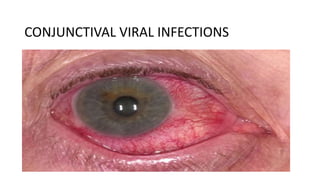 CONJUNCTIVAL VIRAL INFECTIONS
 