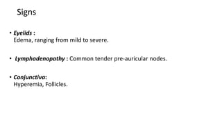 Signs
• Eyelids :
Edema, ranging from mild to severe.
• Lymphadenopathy : Common tender pre-auricular nodes.
• Conjunctiva:
Hyperemia, Follicles.
 
