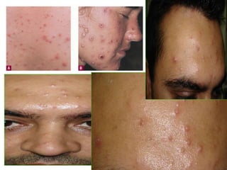 Piyoderma dermatology.Viral diseases.(dr.ali el-ethawe) | PPT