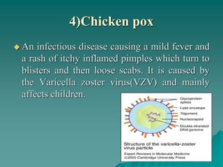 4)Chicken pox
 An infectious disease causing a mild fever and
a rash of itchy inflamed pimples which turn to
blisters and then loose scabs. It is caused by
the Varicella zoster virus(VZV) and mainly
affects children.
 