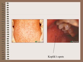 Koplik’s spots
 