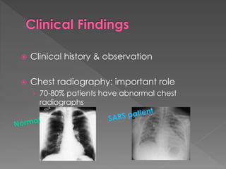  Clinical history & observation
 Chest radiography: important role
› 70-80% patients have abnormal chest
radiographs
 