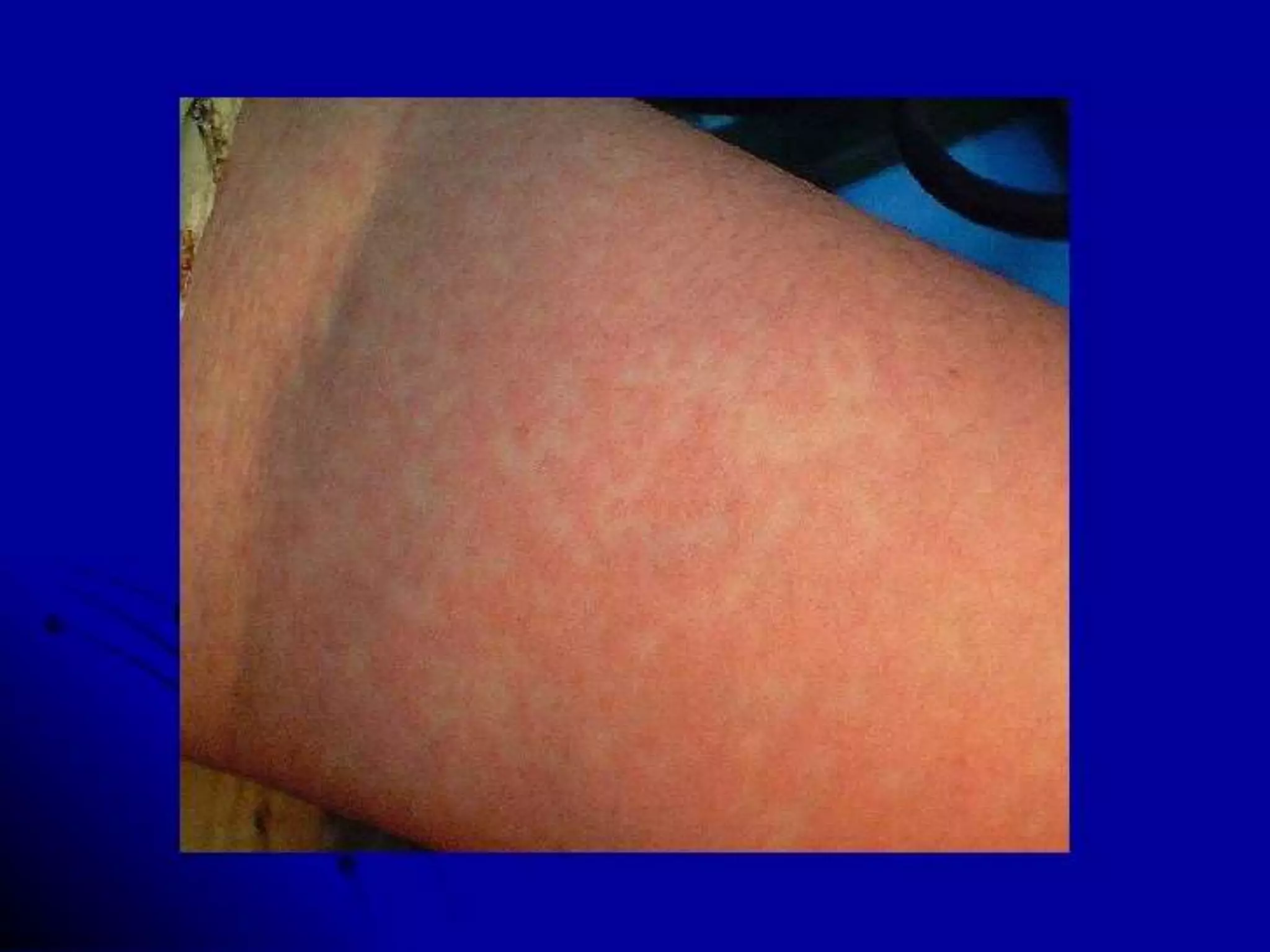 Viral exanthem