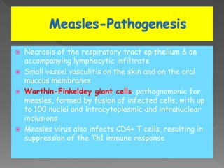  Necrosis of the respiratory tract epithelium & an
accompanying lymphocytic infiltrate
 Small vessel vasculitis on the skin and on the oral
mucous membranes
 Warthin-Finkeldey giant cells: pathognomonic for
measles, formed by fusion of infected cells, with up
to 100 nuclei and intracytoplasmic and intranuclear
inclusions
 Measles virus also infects CD4+ T cells, resulting in
suppression of the Th1 immune response
 
