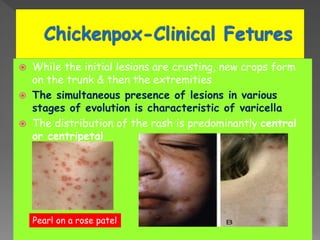  While the initial lesions are crusting, new crops form
on the trunk & then the extremities
 The simultaneous presence of lesions in various
stages of evolution is characteristic of varicella
 The distribution of the rash is predominantly central
or centripetal
Pearl on a rose patel
 