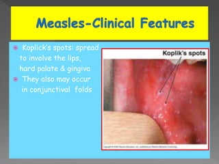  Koplick’s spots: spread
to involve the lips,
hard palate & gingiva
 They also may occur
in conjunctival folds
 